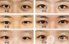 開(kāi)眼角大概多少錢(qián)？開(kāi)眼角價(jià)格一般是多少？