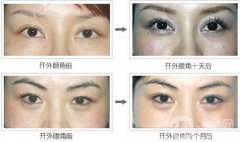 開(kāi)眼角增生多久恢復(fù)?開(kāi)眼角增生恢復(fù)時(shí)間？
