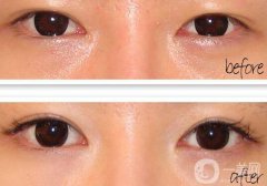 開眼角疼嗎？開眼角痛不痛？