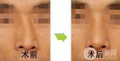 歪鼻矯正一般多少錢(qián)？歪鼻矯正手術(shù)價(jià)格詳細(xì)解析