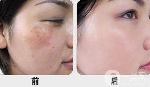 激光調(diào)節(jié)黃褐斑要多少錢？激光祛黃褐斑價(jià)格價(jià)格分析