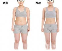 超聲波吸脂減肥果怎么樣？超聲波吸脂減肥多少錢？　　