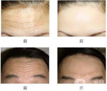 去抬頭紋好的方法？去抬頭紋那種方法好？