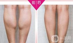 注射瘦腿果好嗎？注射瘦腿多少錢一針？