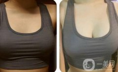 隆乳多少錢(qián) 隆胸價(jià)格與那些因素有關(guān)