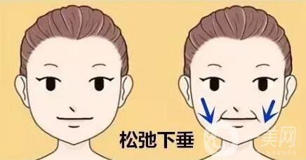 去鼻唇溝多少錢 價格明細(xì)盤點