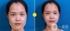 怎么樣讓咬肌變?。吭鯓邮菀Ъ。?></a>
                            <div   id=