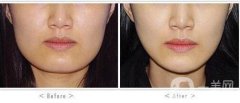 磨下頜角價(jià)格？磨下頜角多少錢？