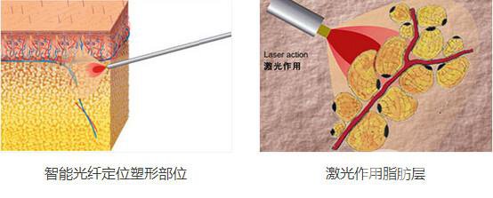 光纖溶脂減肥*果嗎?有哪些注意事項？