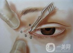 開眼角有風險嗎？開眼角風險有哪些？