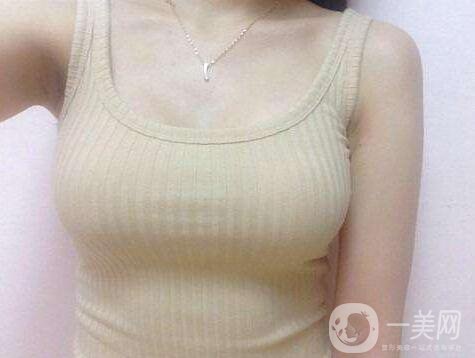 娜高假體隆胸多少錢？收費情況說明~