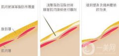 溶脂的價(jià)格一般是多少？溶脂一般多少錢？
