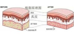 吸脂價(jià)格多少？吸脂價(jià)格詳細(xì)分析