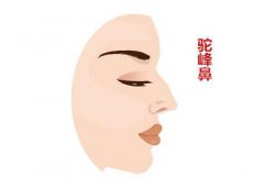 駝峰鼻矯正方法？如何矯正駝峰鼻