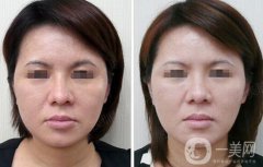 光子嫩膚大概要多少錢？光子嫩膚價格詳解