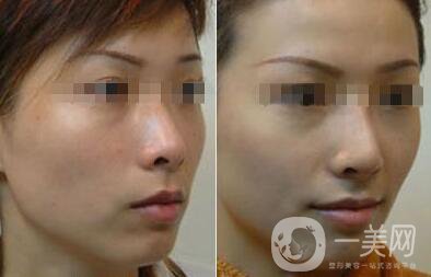 光子嫩膚大概要多少錢？光子嫩膚價(jià)格詳解