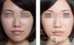 彩光嫩膚要多少錢？彩光嫩膚價(jià)格需要多少？