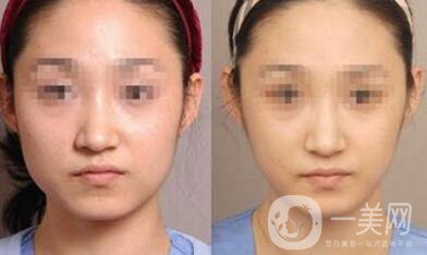 去頰脂墊要多少錢？去頰脂墊價(jià)格詳解
