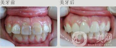 四環(huán)素牙怎么變白？四環(huán)素牙怎么辦？