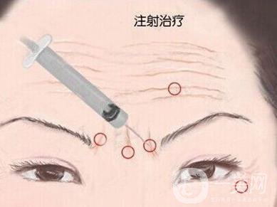 *生物除皺*果好不好？有副作用嗎？