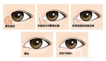韓式開眼角多少錢？價格很貴嗎？