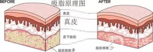 吸脂的價格一般是多少？價格差異大嗎？