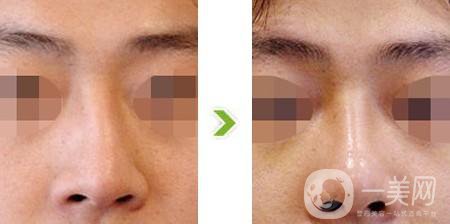 歪鼻矯正費(fèi)用大概是多少？?jī)r(jià)格影響因素有哪些？