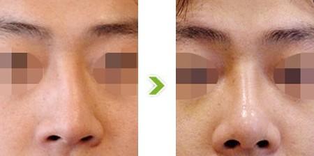 歪鼻矯正費(fèi)用大概是多少？價(jià)格影響因素有哪些？