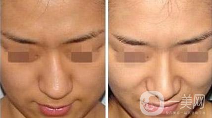 烤瓷牙有哪些種類？多久可以恢復(fù)？