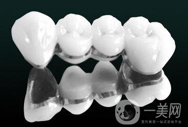 烤瓷牙有哪些種類？多久可以恢復(fù)？