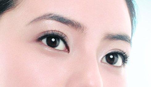 焊接雙眼皮是什么？手術(shù)后多久能好？