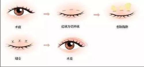 焊接雙眼皮是什么？手術(shù)后多久能好？
