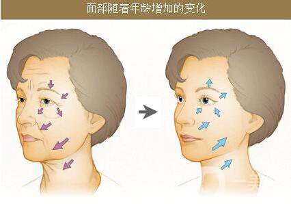 生物除皺的價(jià)格是多少 生物除皺收費(fèi)明細(xì)