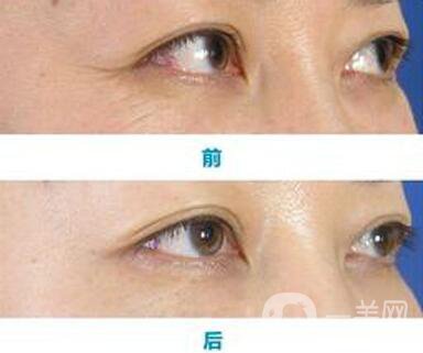 怎樣去魚尾紋*果好？去除魚尾紋的方法介紹