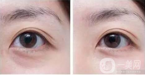 自體脂肪填充眼眶注意事項(xiàng)主要有哪些？