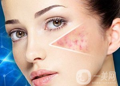 像素激光去痘坑*果怎么樣？怎樣很好的調節(jié)*果？
