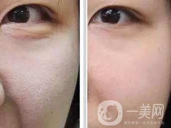 果酸換膚后注意事項盤點大揭秘，該怎么做？