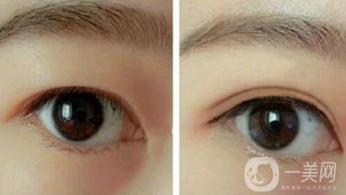 韓式三點(diǎn)雙眼皮是埋線還是割？手術(shù)*果怎么樣