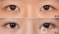 高分子埋線是*的嗎？可以維持幾年？