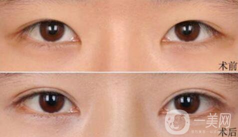 高分子埋線是*的嗎？可以維持幾年？