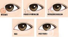 開眼角果有哪些、開眼角手術(shù)的果怎么樣？