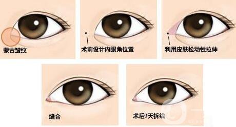 開眼角*果有哪些、開眼角手術(shù)的*果怎么樣？