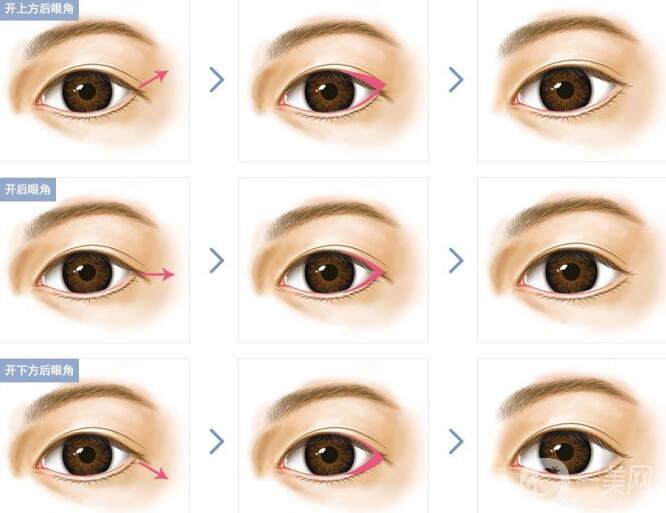 開眼角*果有哪些、開眼角手術(shù)的*果怎么樣？