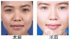 自體脂肪豐鼻唇溝有什么優(yōu)勢？果怎么樣呢？