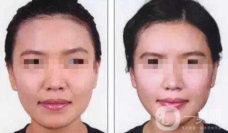 自體脂肪豐鼻唇溝有什么優(yōu)勢(shì)？*果怎么樣呢？