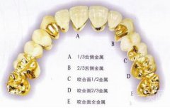 黃金烤瓷牙多少錢一顆？黃金烤瓷牙價格詳解