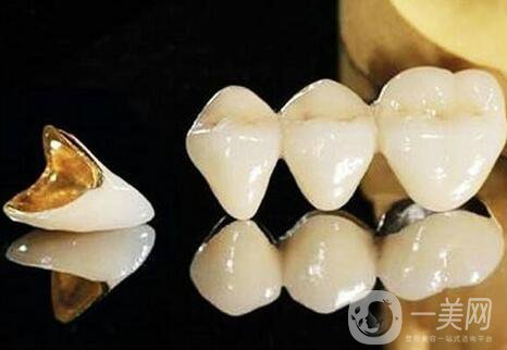 黃金烤瓷牙多少錢一顆？黃金烤瓷牙價格詳解