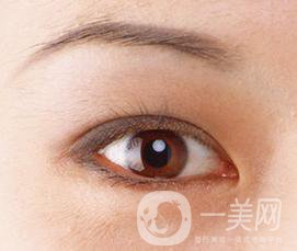 生物焊接雙眼皮是什么？有什么特點(diǎn)？