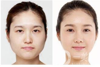 生物焊接雙眼皮是什么？有什么特點(diǎn)？