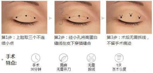 三點(diǎn)式雙眼皮*果一般能撐幾年？